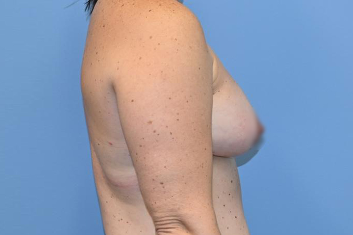 Breast Reconstruction Before & After Patient #804