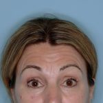 Xeomin&reg; Before & After Patient #801