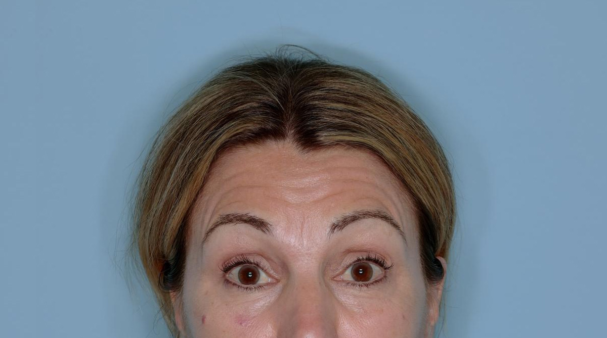 Xeomin® Before & After Patient #801