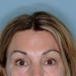 Xeomin&reg; Before & After Patient #801