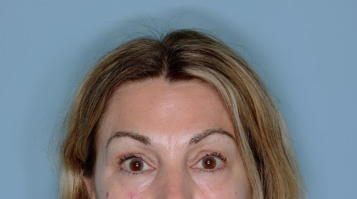 Xeomin® Before & After Patient #801