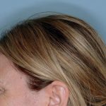 Xeomin&reg; Before & After Patient #801