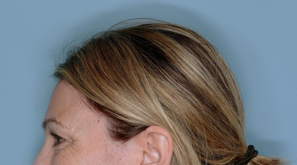 Xeomin® Before & After Patient #801