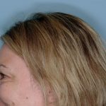 Xeomin&reg; Before & After Patient #801