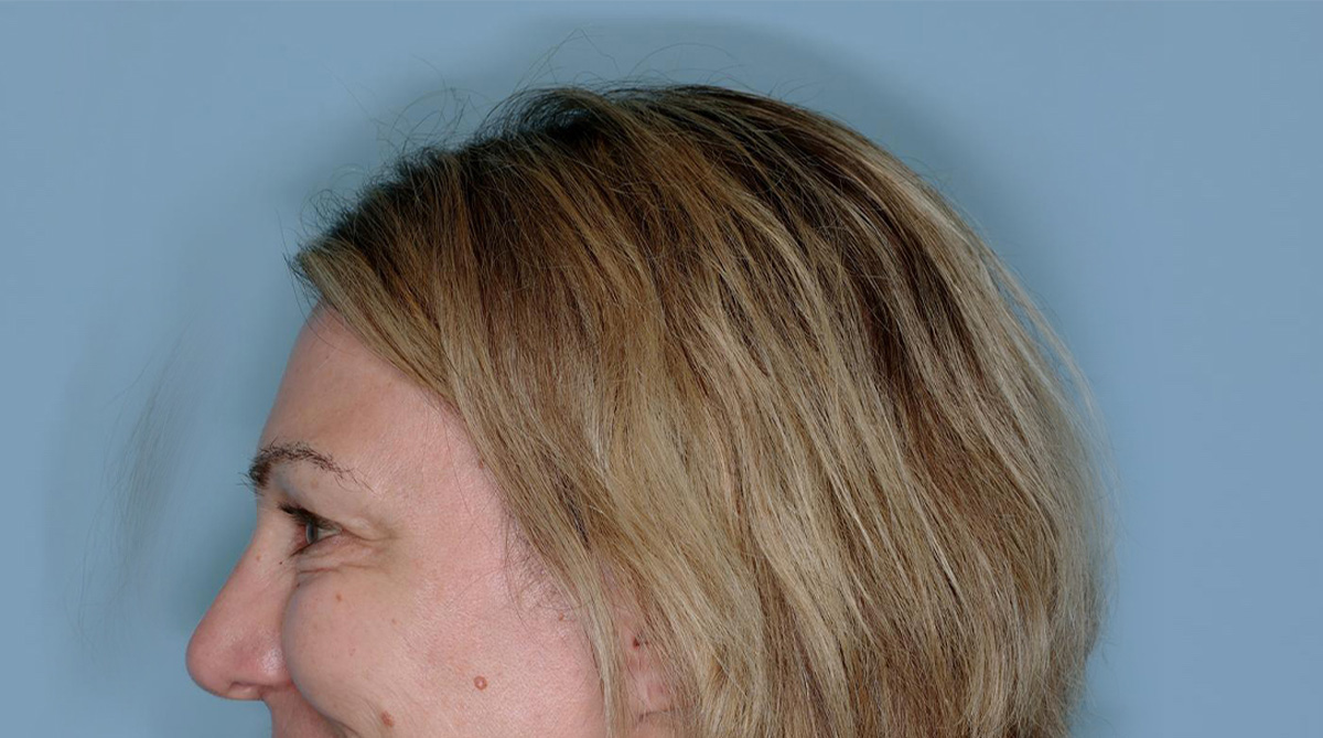 Xeomin® Before & After Patient #801