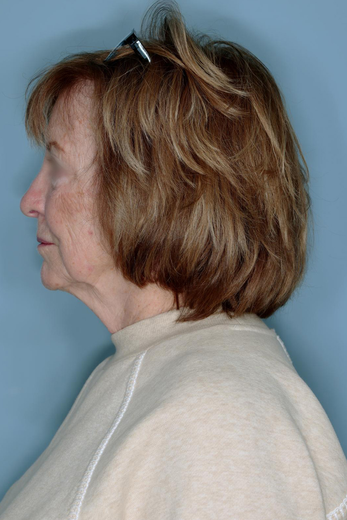 Melanoma Skin Graft Before & After Patient #861
