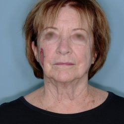 Melanoma Skin Graft Before & After Patient #861
