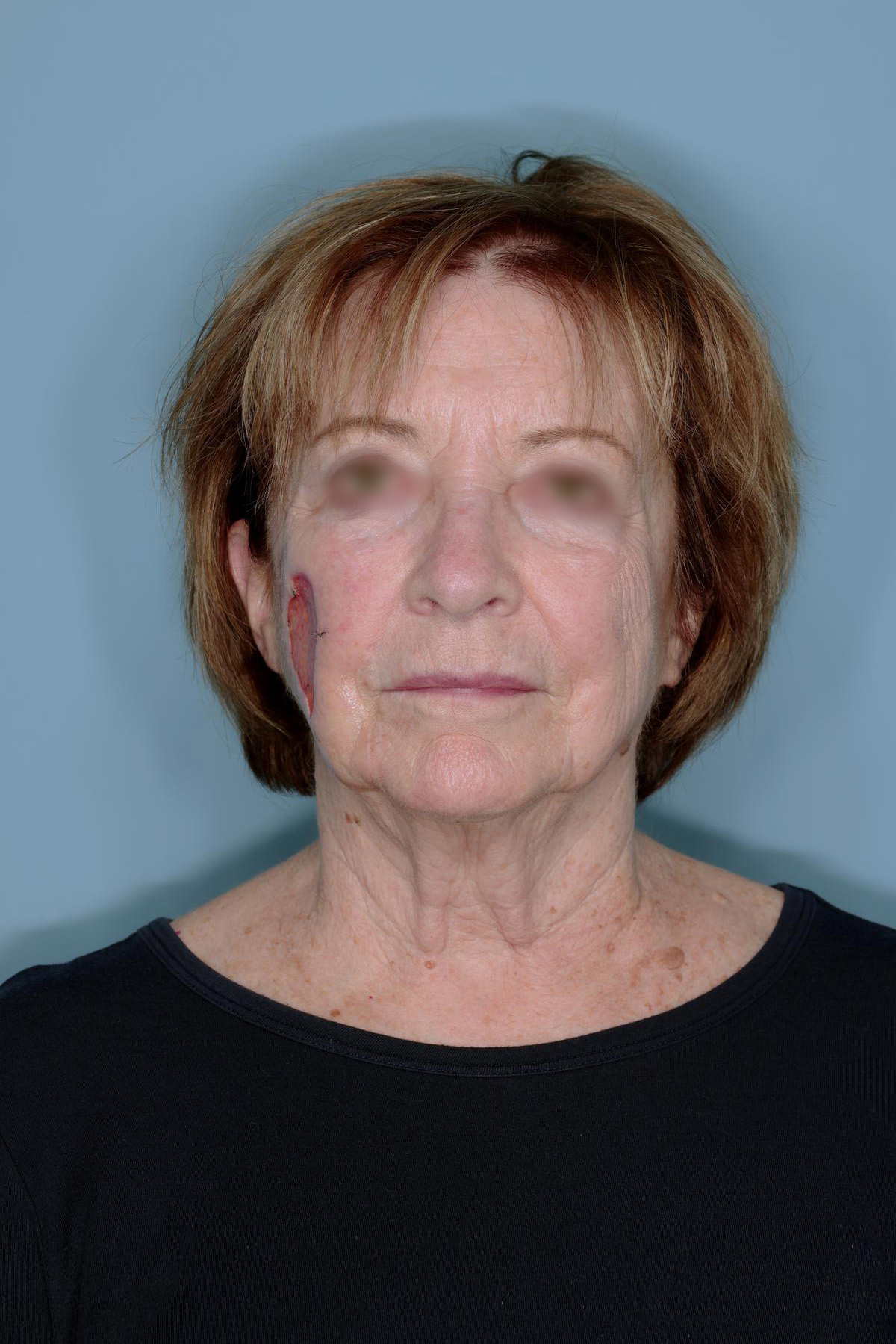 Melanoma Skin Graft Before & After Patient #861