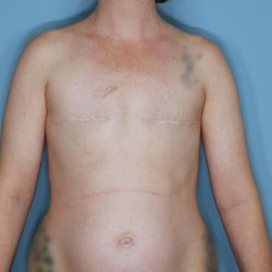 Breast Reconstruction Before & After Patient #859