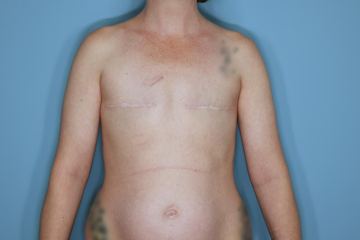 Breast Reconstruction Before & After Patient #859