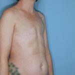 Breast Reconstruction Before & After Patient #859