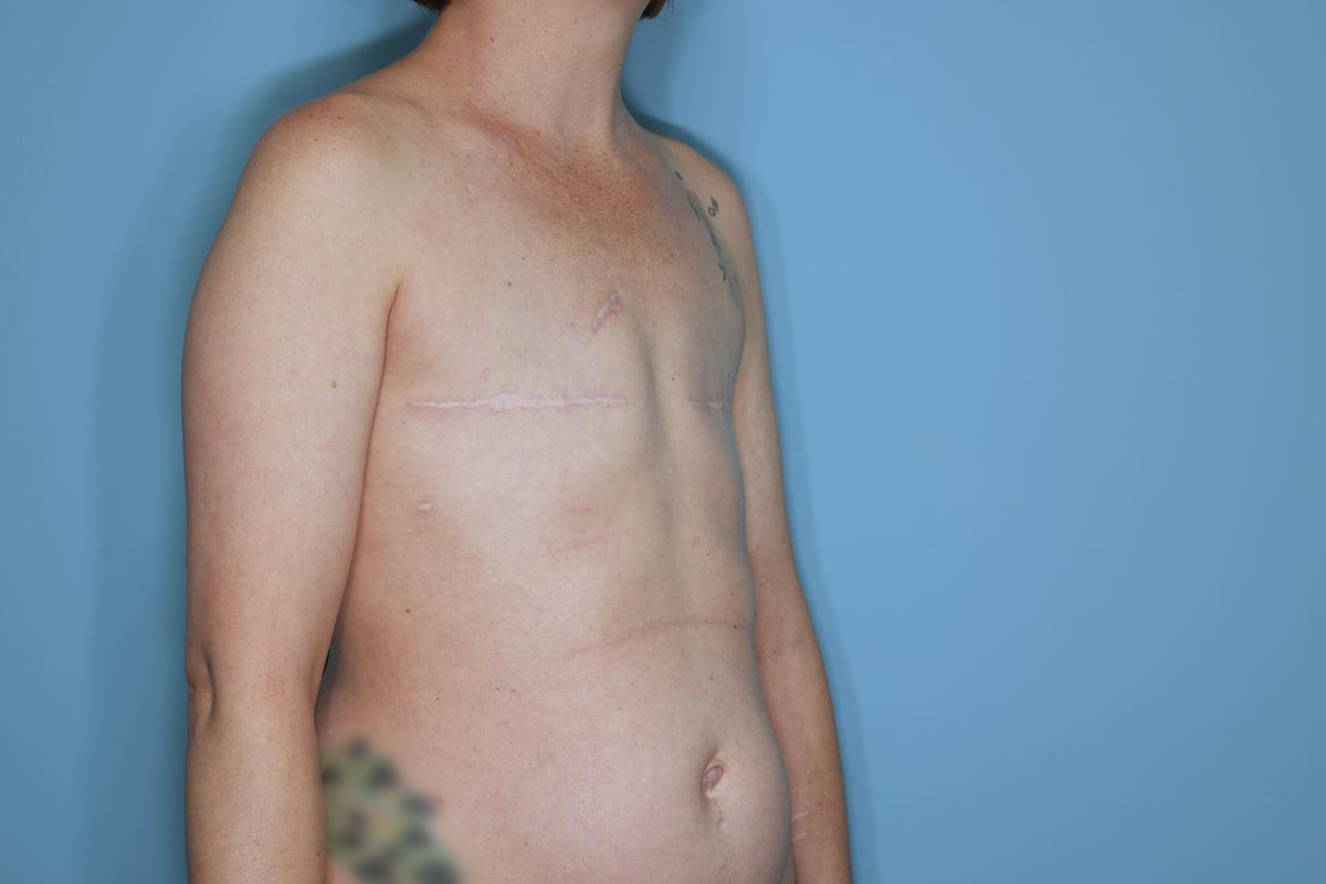 Breast Reconstruction Before & After Patient #859