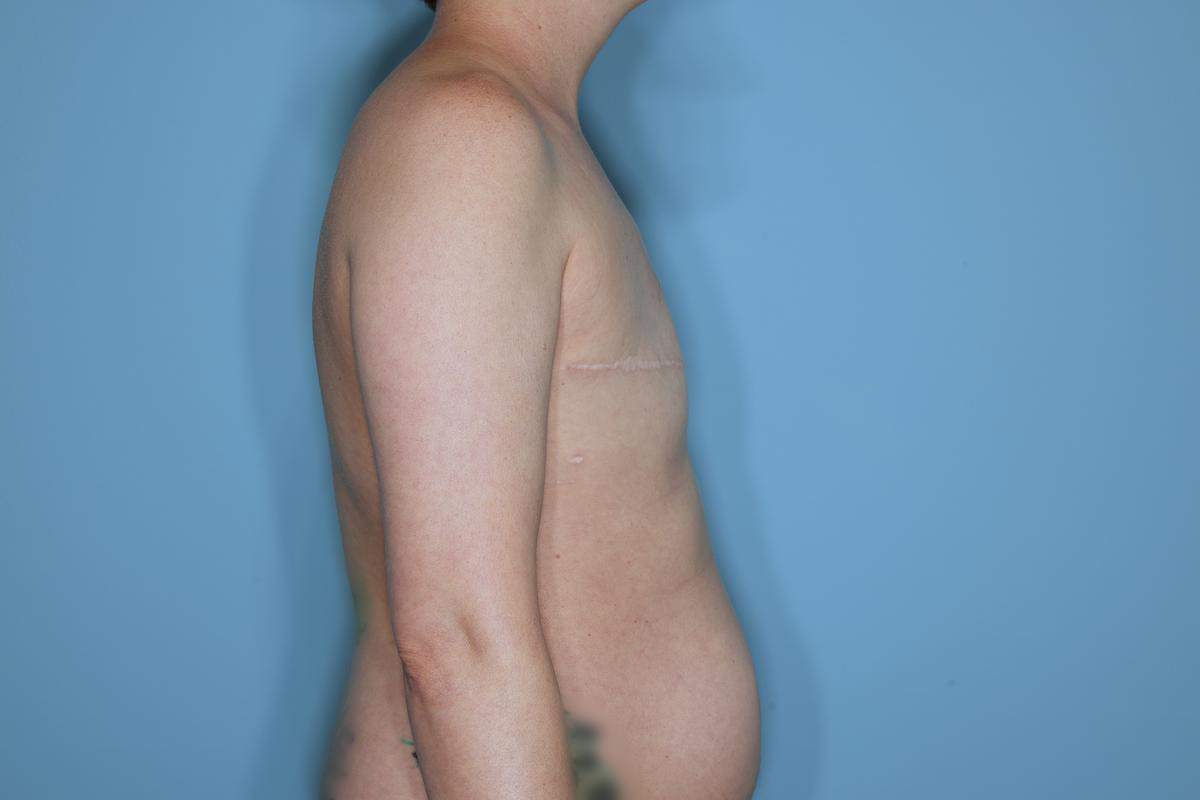 Breast Reconstruction Before & After Patient #859