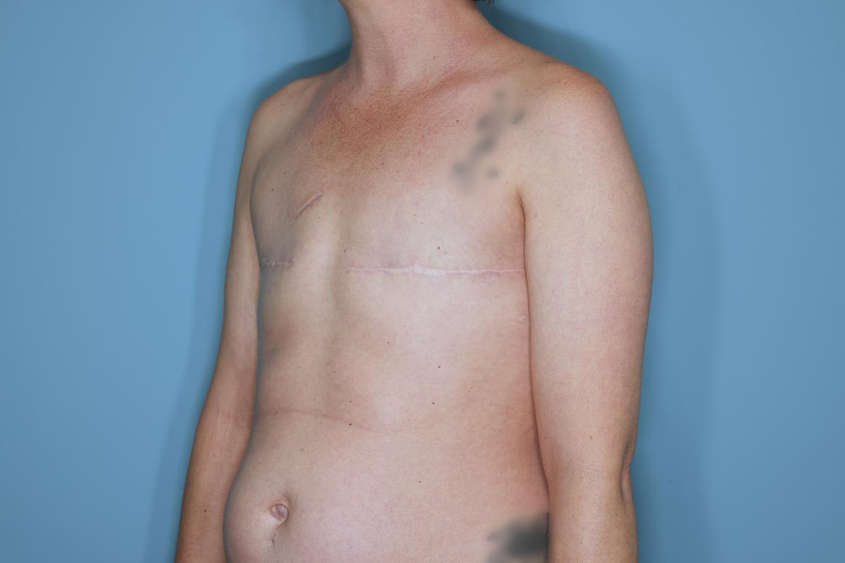 Breast Reconstruction Before & After Patient #859