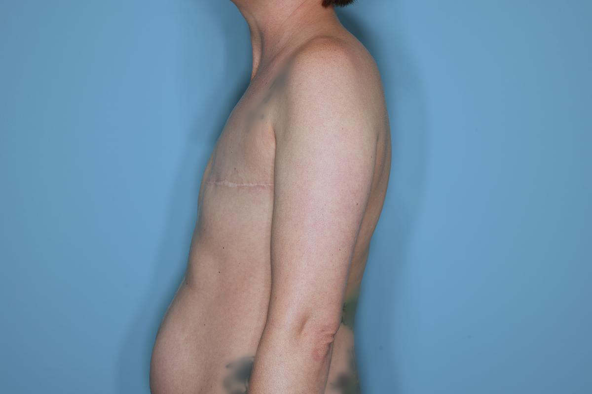 Breast Reconstruction Before & After Patient #859