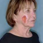 Melanoma Skin Graft Before & After Patient #861