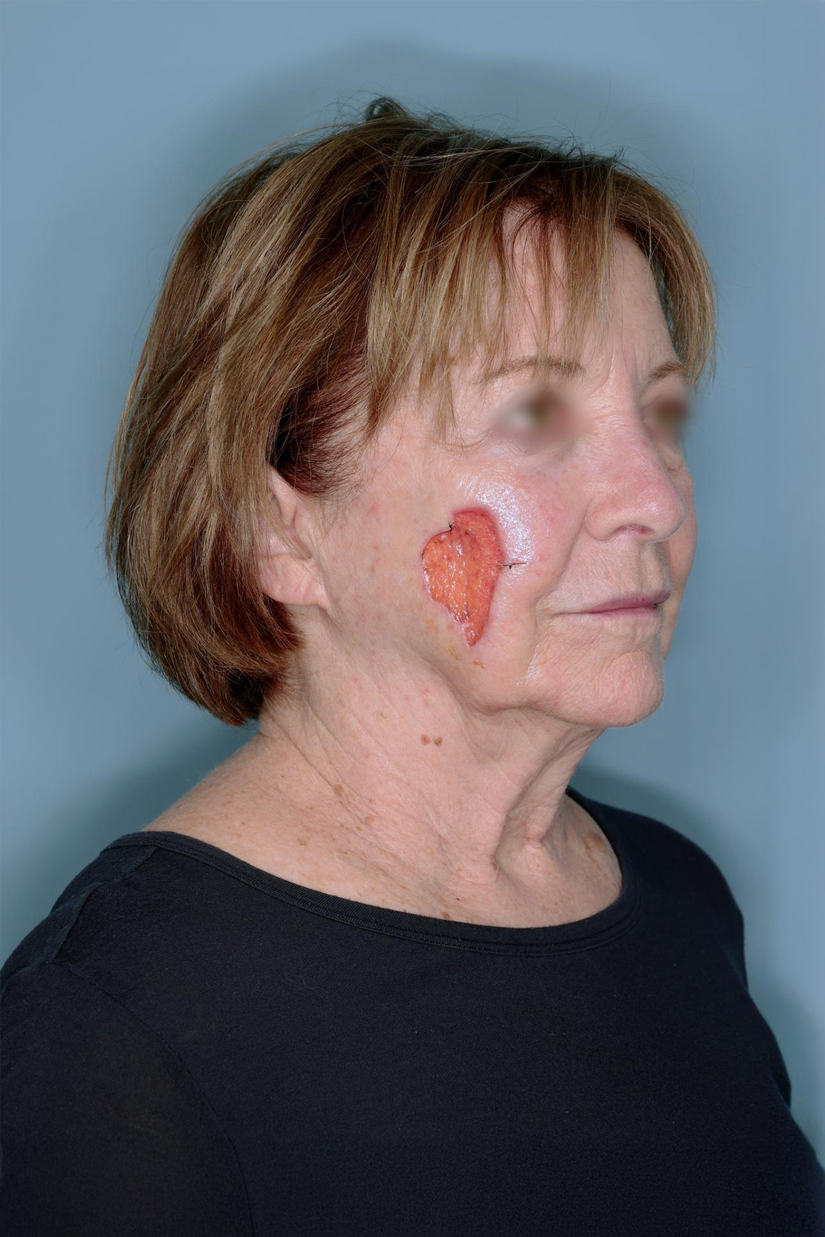 Melanoma Skin Graft Before & After Patient #861