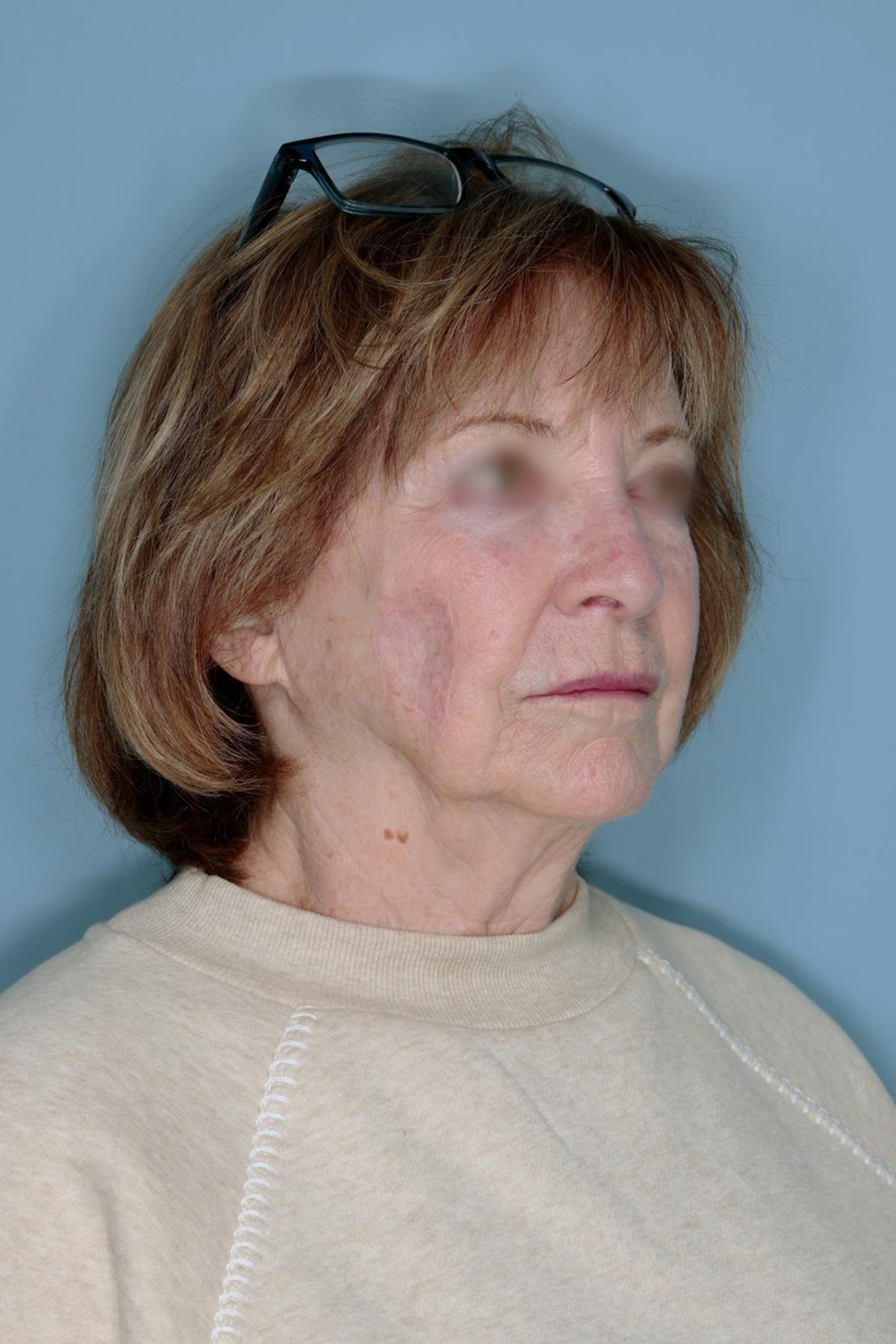 Melanoma Skin Graft Before & After Patient #861