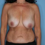 Breast Reconstruction Before & After Patient #860