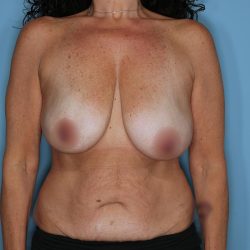 Breast Reconstruction Before & After Patient #860