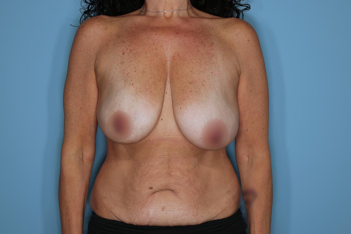 Breast Reconstruction Before & After Patient #860