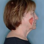 Melanoma Skin Graft Before & After Patient #861