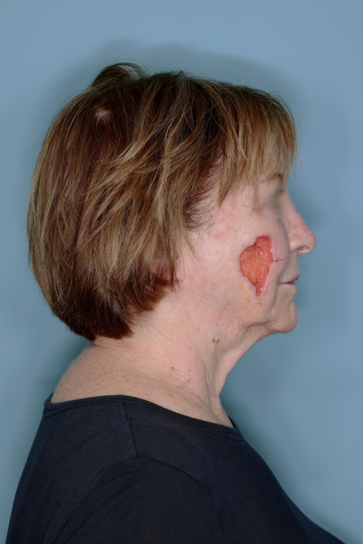 Melanoma Skin Graft Before & After Patient #861