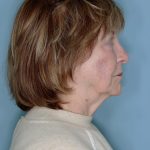 Melanoma Skin Graft Before & After Patient #861