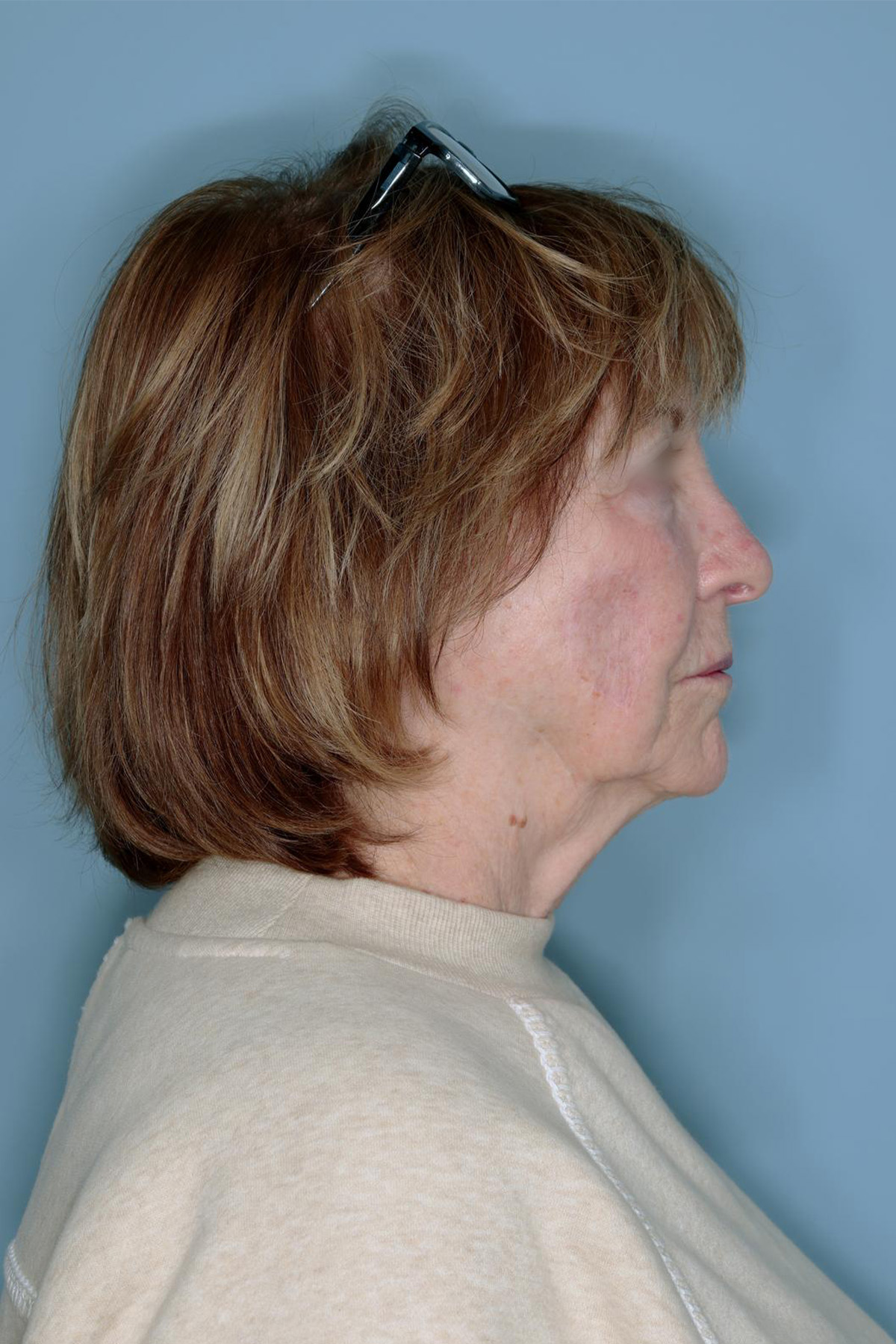 Melanoma Skin Graft Before & After Patient #861