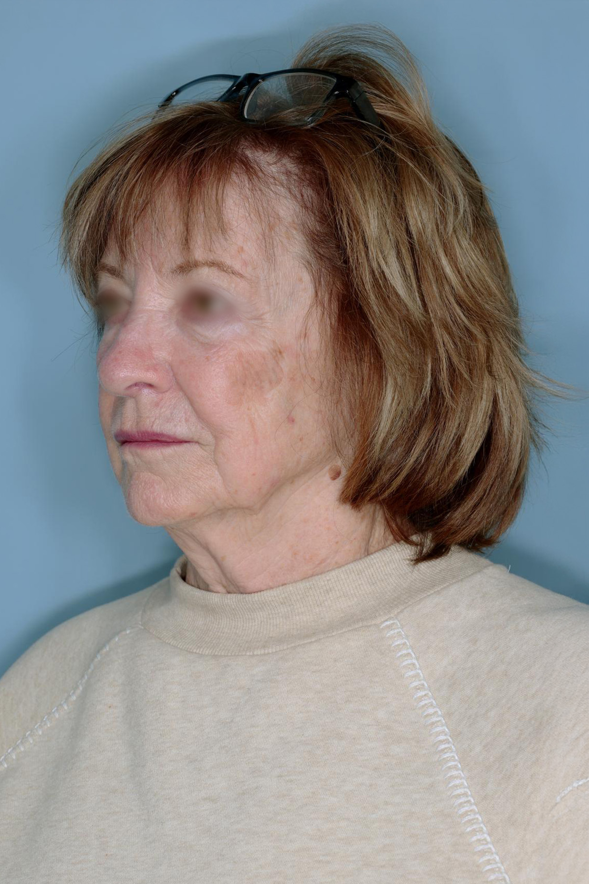 Melanoma Skin Graft Before & After Patient #861