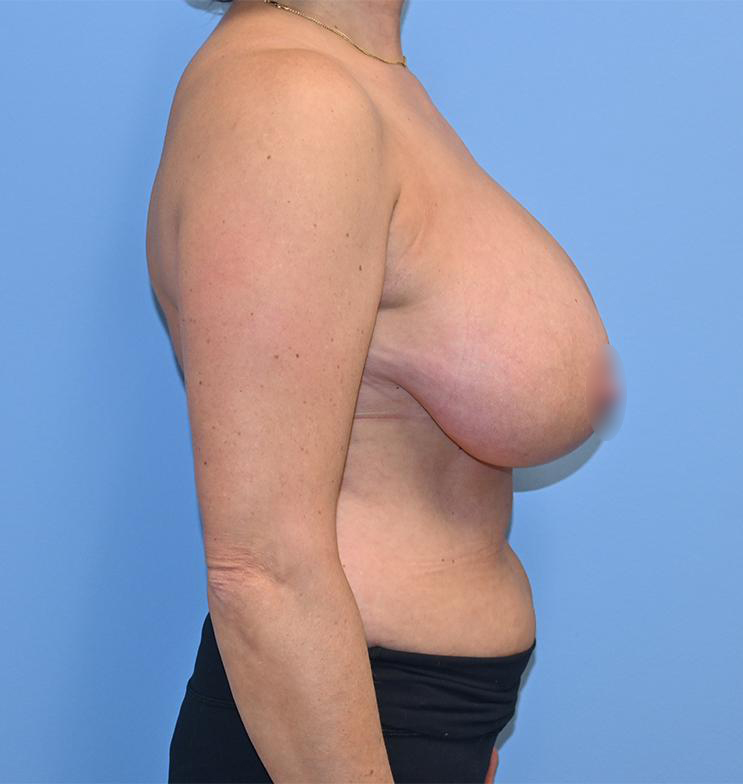 Breast Reduction Before & After Patient #863