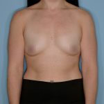 Breast Augmentation Before & After Patient #1446