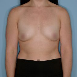 Breast Augmentation Before & After Patient #1446