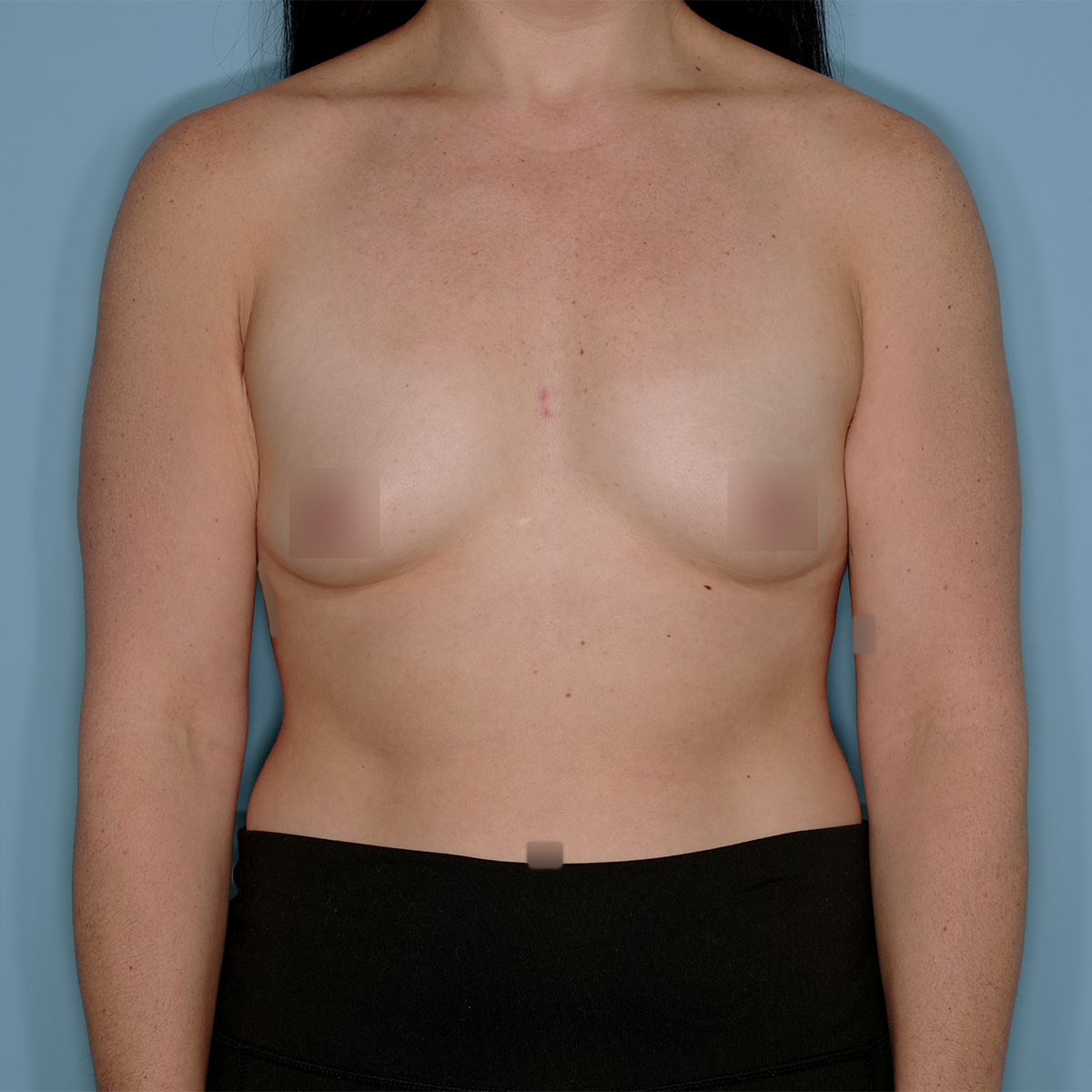 Breast Augmentation Before & After Patient #1446
