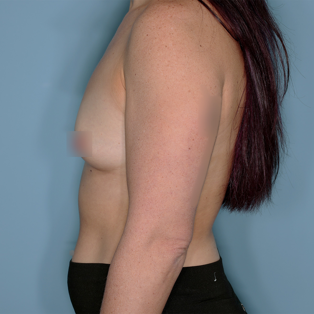 Breast Augmentation Before & After Patient #1446