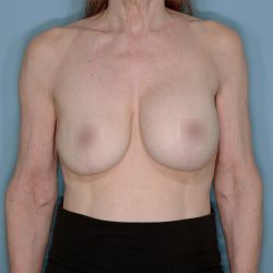Implant Exchange Lift Before & After Patient #1447