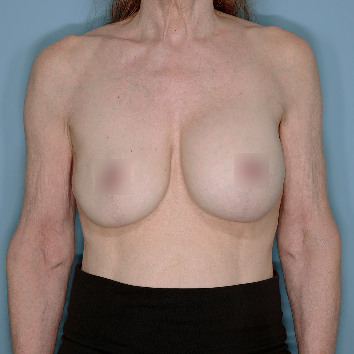 Implant Exchange Lift Before & After Patient #1447