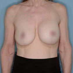 Implant Exchange Before & After Patient #1540